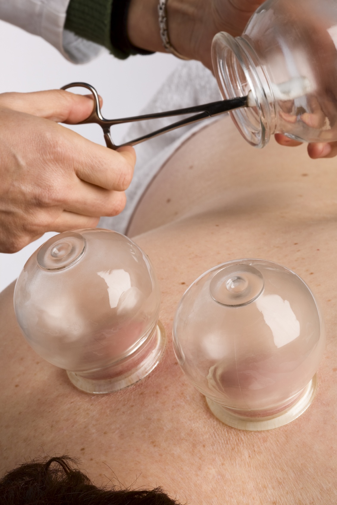 Vacuum cupping / Fire Cupping
