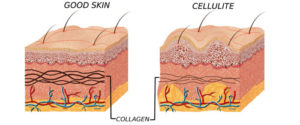 good skin vs cellulite