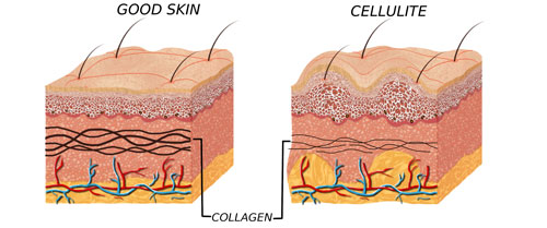 good skin vs cellulite