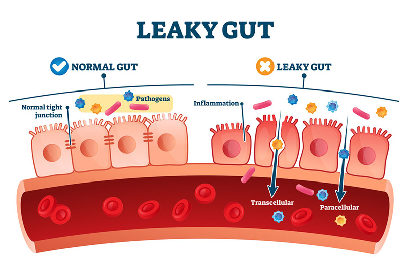 leaky gut