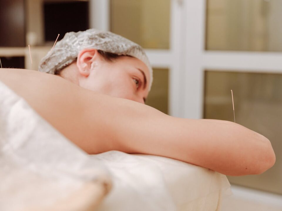 Acupuncture in progress